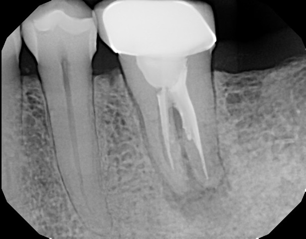 View of an x-ray as part of a dental treatment plan without using the charting software's drawing tool; far less useful