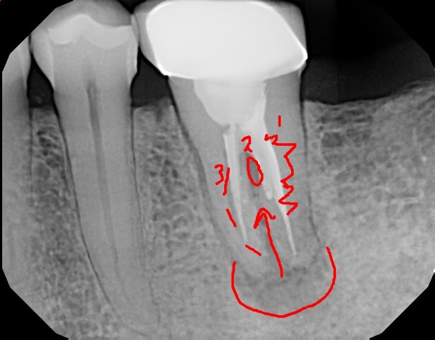View of an x-ray as part of a dental treatment plan using the charting software's drawing tool 